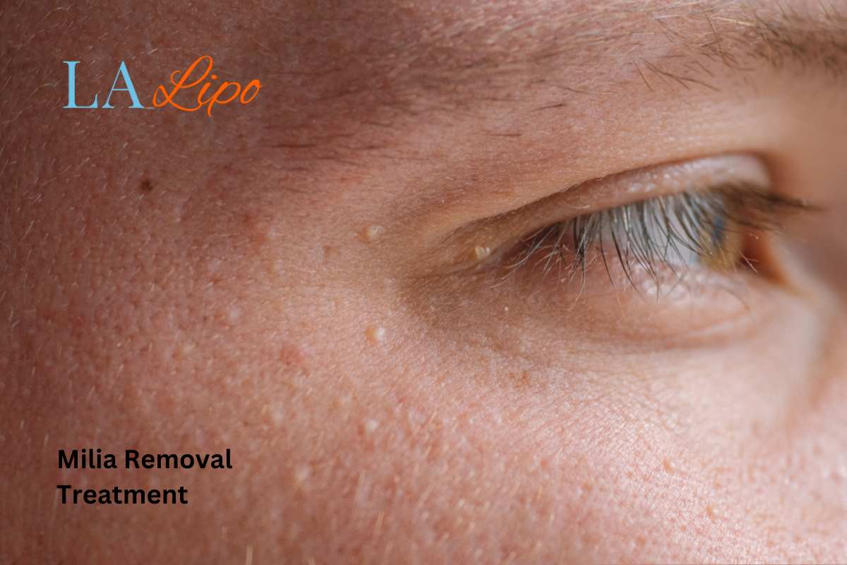 Cryopen Milia Removal: Is It the Easiest and Safest Option Bournville?