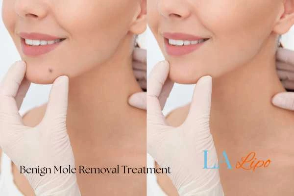 woman's before and after mole removal Bournville results