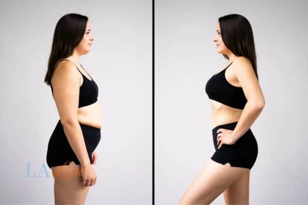 image of woman before and after results of LA-EMS Body Sculpting Bournville to help treat Diastasis recti