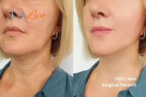 hi-fu for wrinkles Bournville before and after results