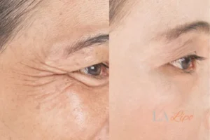 Before and after results of woman - HI-fu wrinkles reduction treatment Bournville
