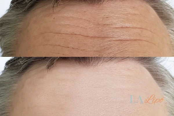 results of HIFU Bournville on mans forehead to help reduce lines and wrinkles
