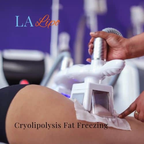 fat freezing - Cryolipolysis Bournville
