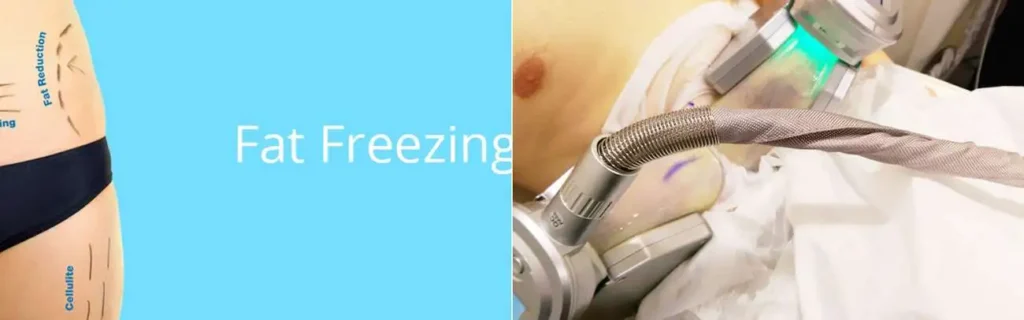 Fat freezing Bournville on multiple areas of the body