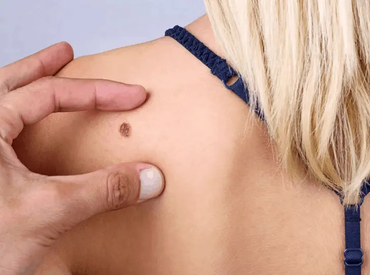 woman having mole removal Bournville consultation before treatment.