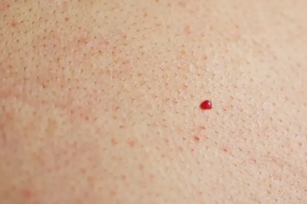 close up of a cherry angioma Bournville