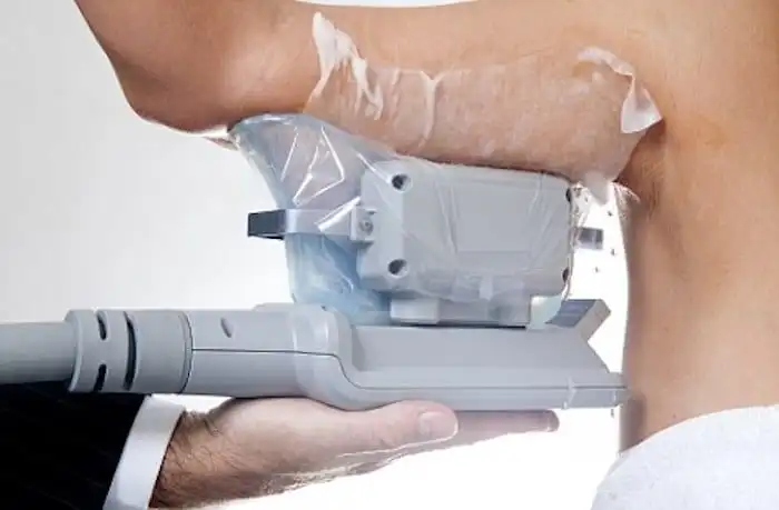 Picture of fat freezing Bournville on the upper arms.