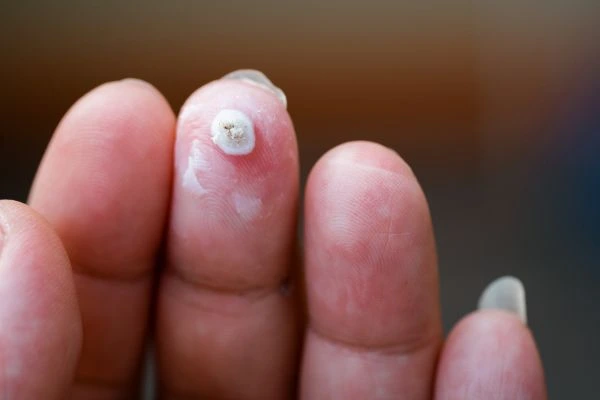 wart on person finger - cryotherapy to treat from LA LIPO Bournville