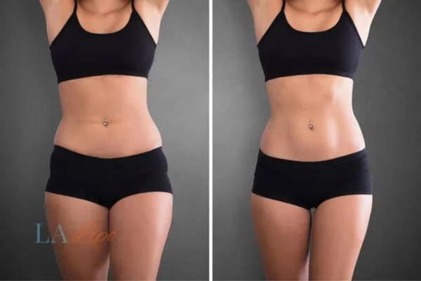 before and after results of non-surgical treatment to help a woman's body image and mental health Bournville