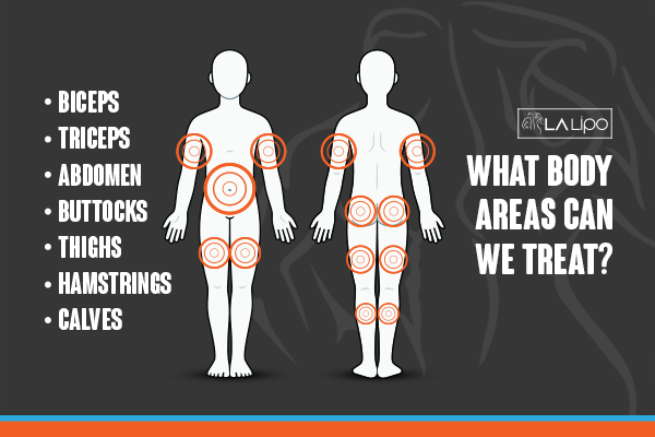 Diagram to show areas you can have LA-EMS Body Sculpting Treatment Bournville