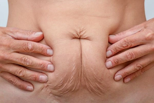Image of a woman's stomach with loose skin - example of skin tightening Bournville options